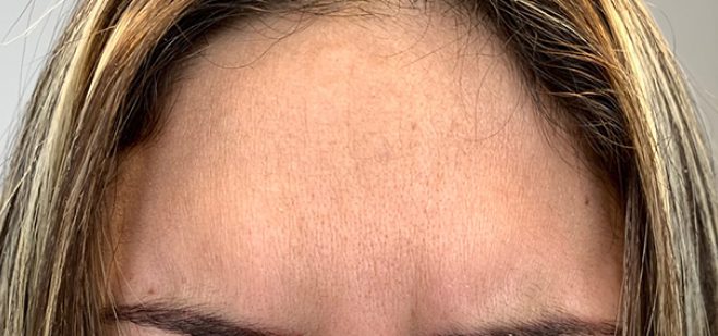 Botox for forehead wrinkles