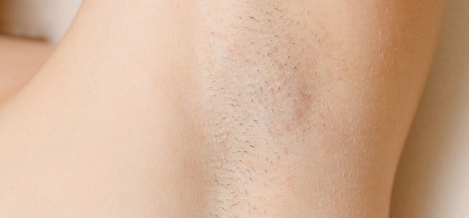 Armpit Laser Hair Removal in North Hollywood | Pure Skin Laser Center