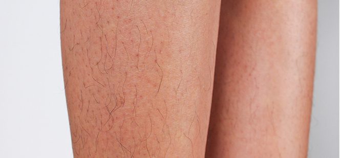 Legs Laser Hair Removal