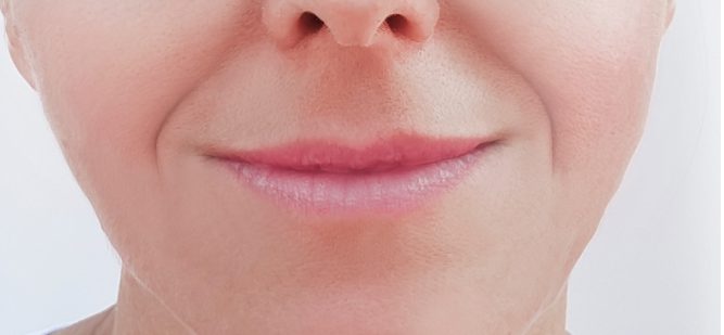 Botox lip flip