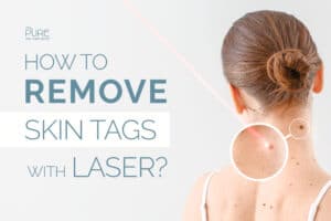 How to remove skin tags with Laser in north hollyowood