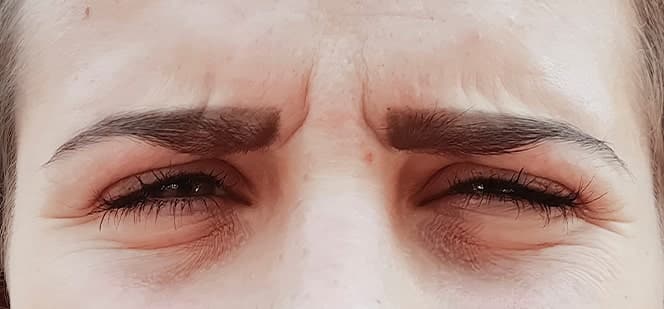 Botox  around eyes