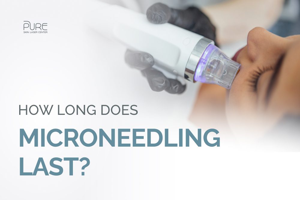 How Long Does Microneedling Last?