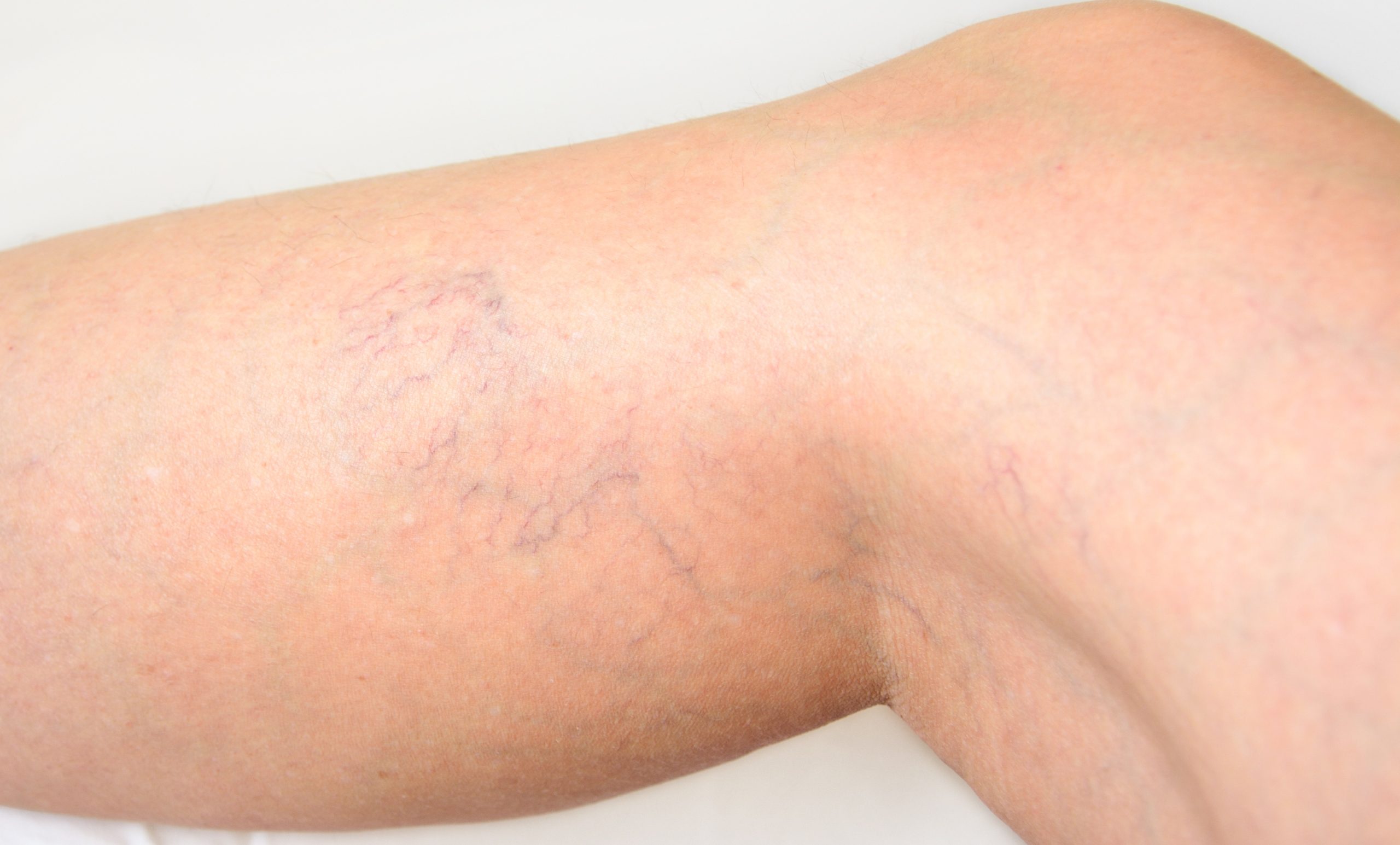 How Long Do I Wear Compression Stockings After Spider Vein Treatment?
