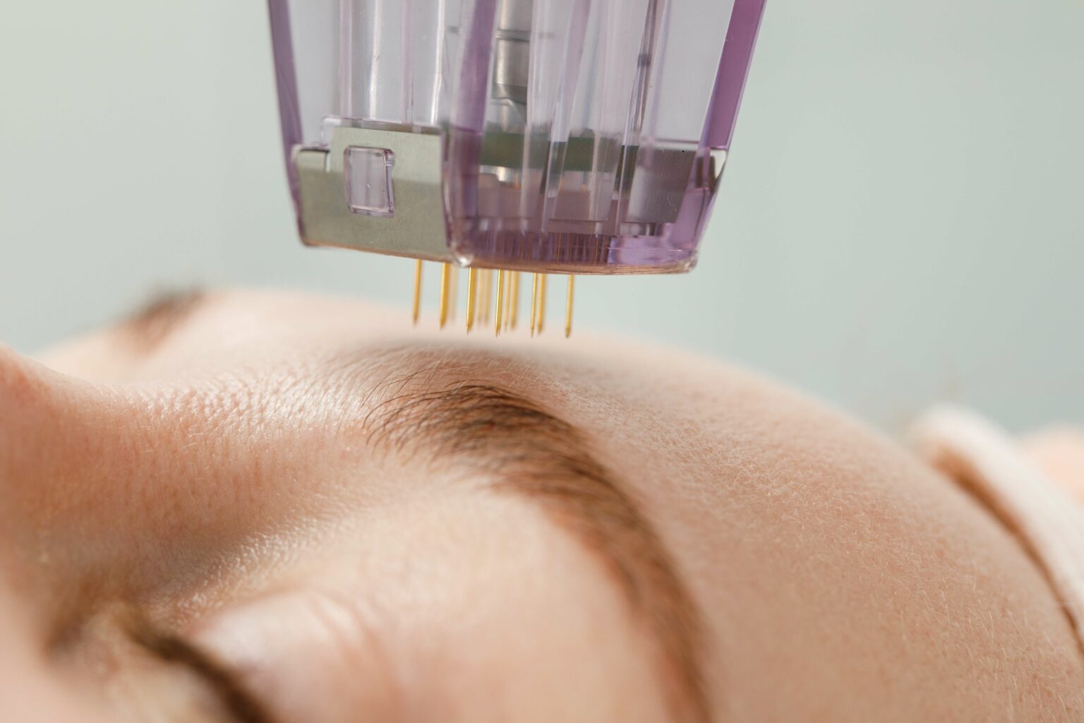 Discover the Healing Power of Microneedling for Scar Treatment