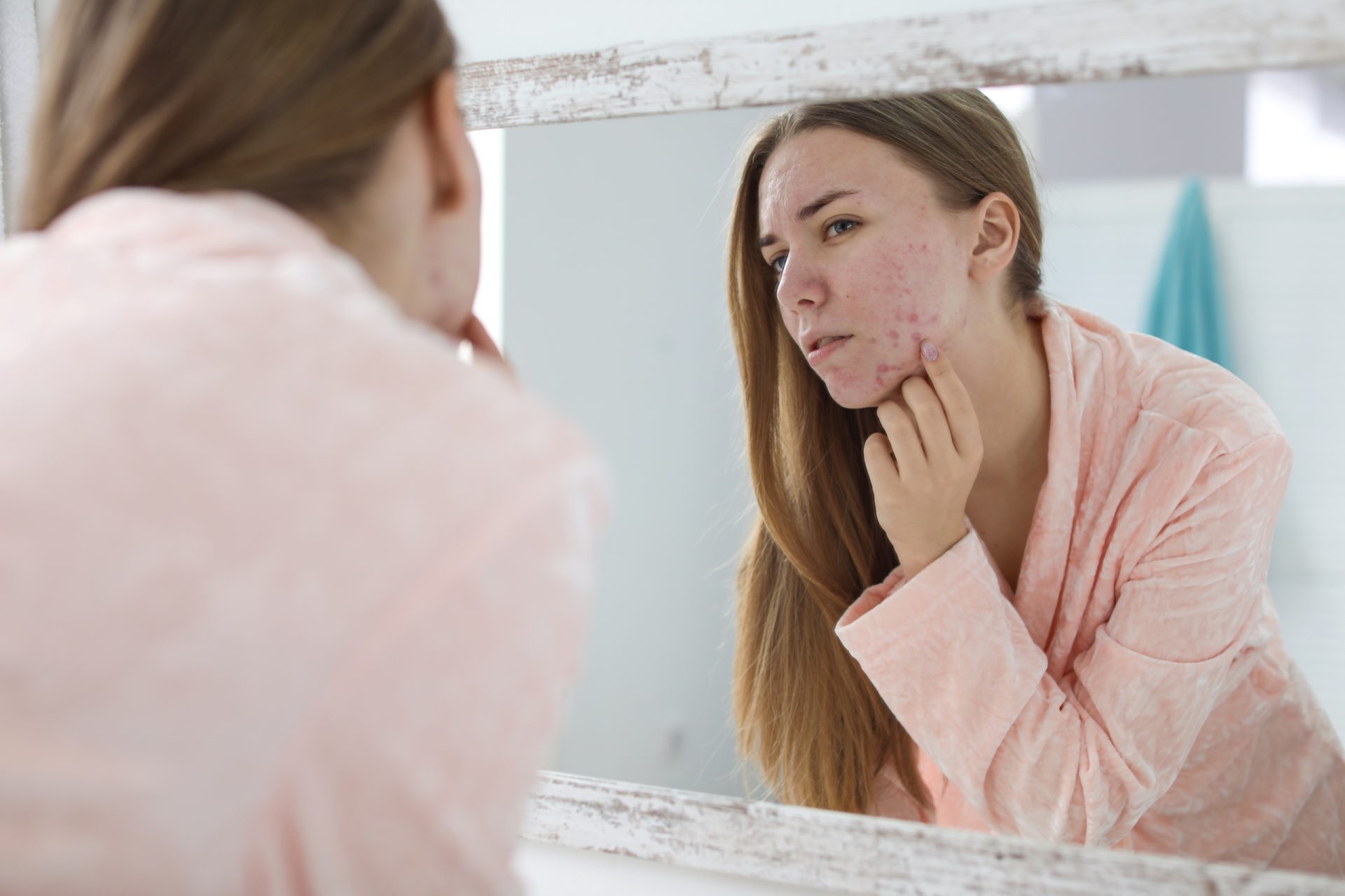 Debunking Common Myths About Acne and Food