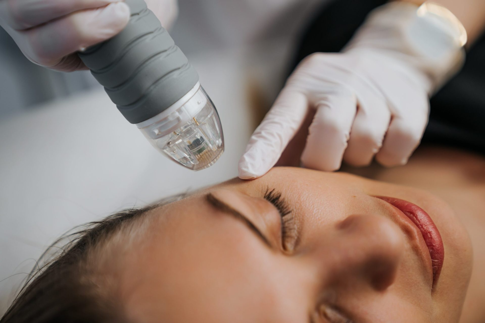 Discover the Healing Power of Microneedling for Scar Treatment